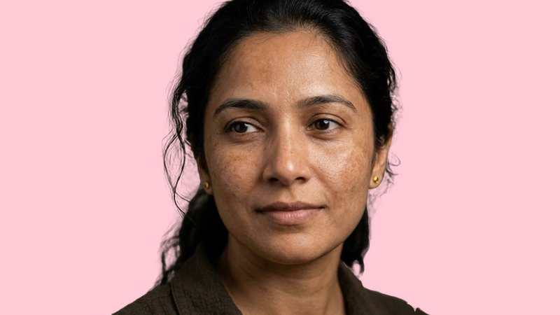 Melasma Explained: Causes, Triggers, and How to Manage It Long-Term