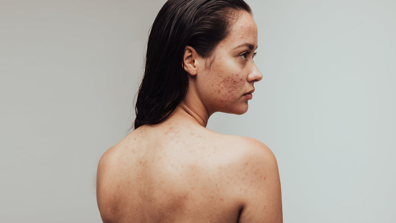 Back Acne: Why It Happens and How to Treat It Properly