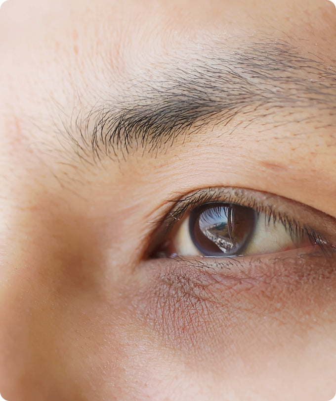 Dark Circles