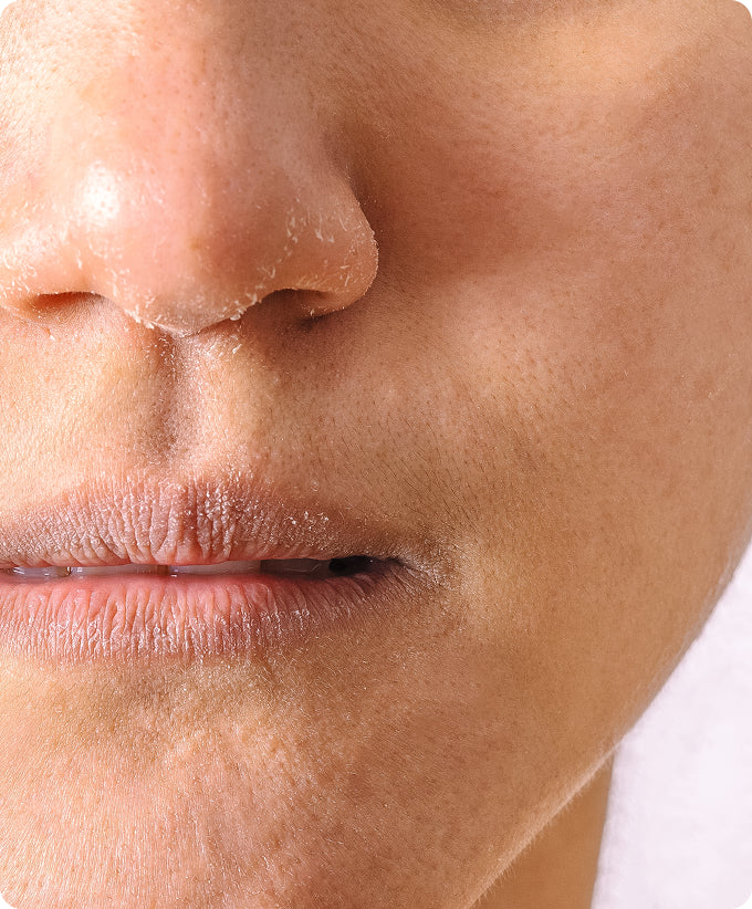 Dry Lips