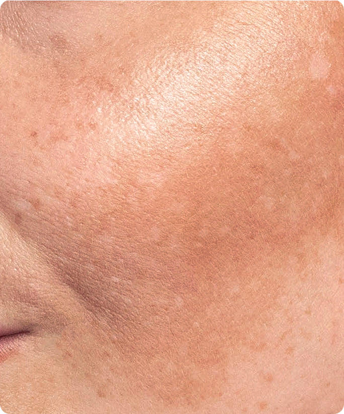 Pigmentation